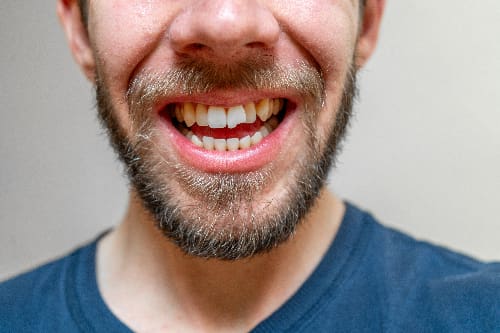 closeup of a man in blue shirt with a chipped front tooth